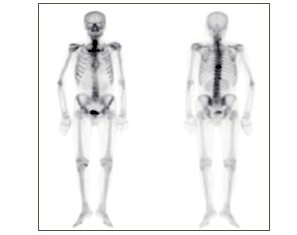 전신 골주사 (Bone scan) 검사