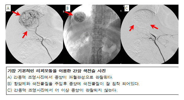 가장 기본적인 리피오돌을 이용한 간암 색전술 사진