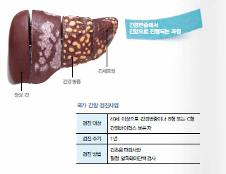 생존율 거꾸로 가는 간암, 앎으로 예방하자! | 질병정보 | 가톨릭대학교 대전성모병원